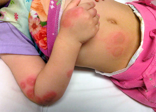 Bedbugs bērniem ir īpaši bīstami, un tiem var būt ilgtermiņa sekas.